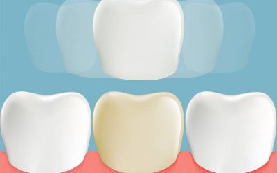 Are Veneers For You?