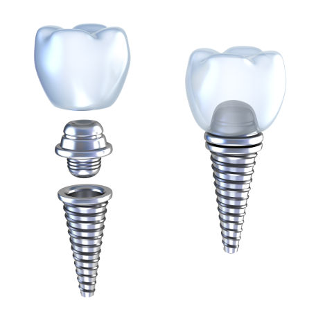 Dental Implants